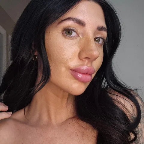 Buy Me A Lip Filler Top Up