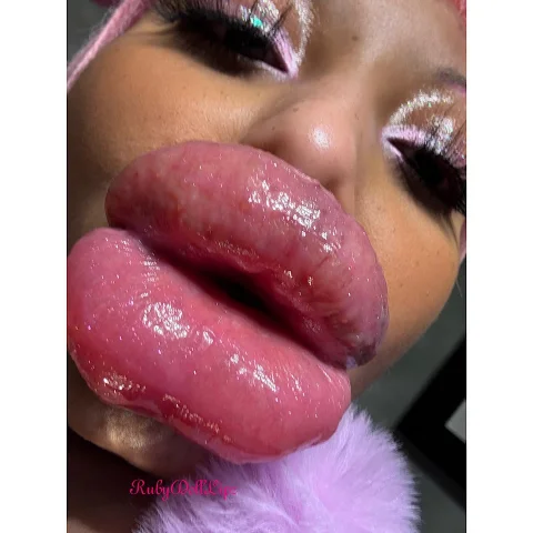 38 Pics 2nd Day Swelling From 4 7 26