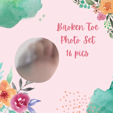 Broken Toe Pics